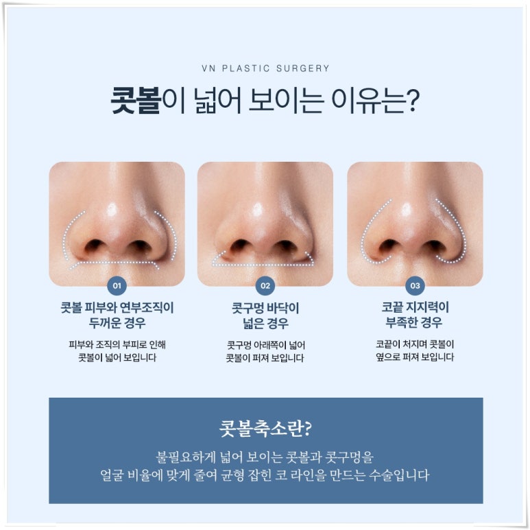 Concerned About Wide Nostrils? What to Know Before Consulting About Alar Reduction | 브이엔성형외과 image 2