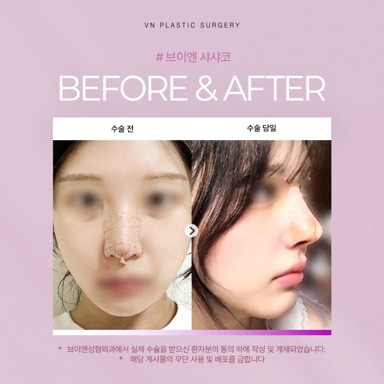 Closed Rhinoplasty Using Autologous Cartilage, Naturally Completed with VN Plastic Surgery’s ShashaKo ✨ image 3