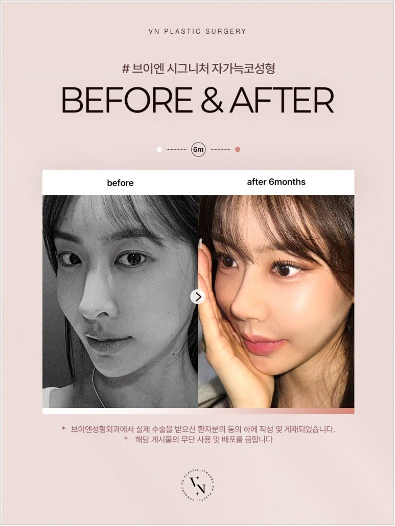 자가늑 코수술 통증과 회복 기간, 늑연골 채취 후 주의 사항까지 관련 이미지 3