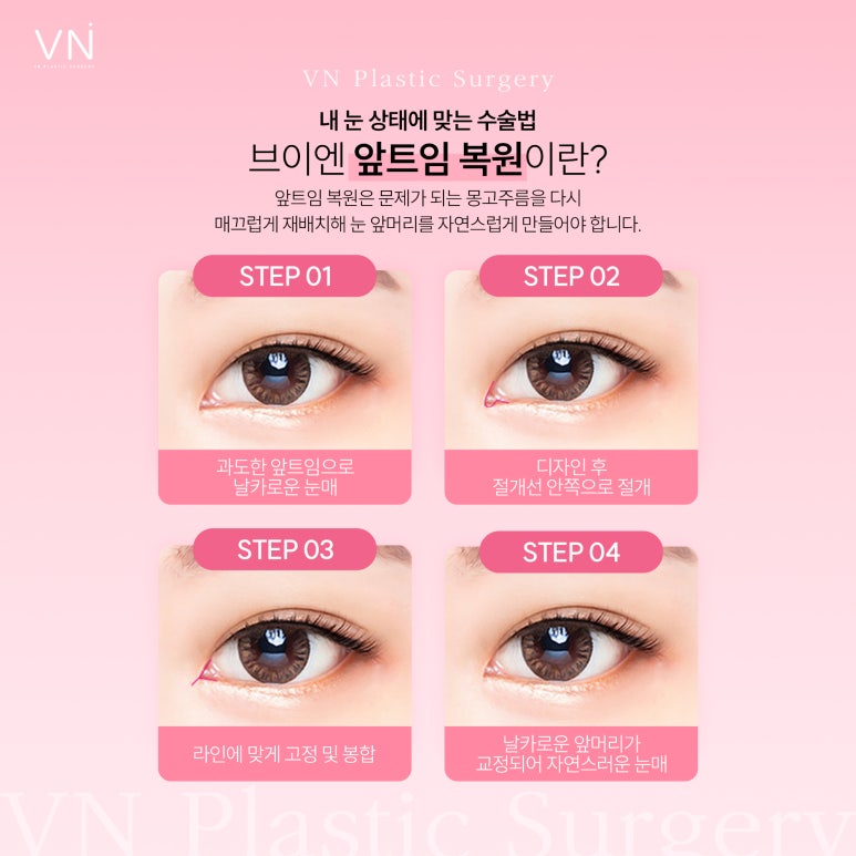 Correction of canthoplasty, when can it be done? image 3