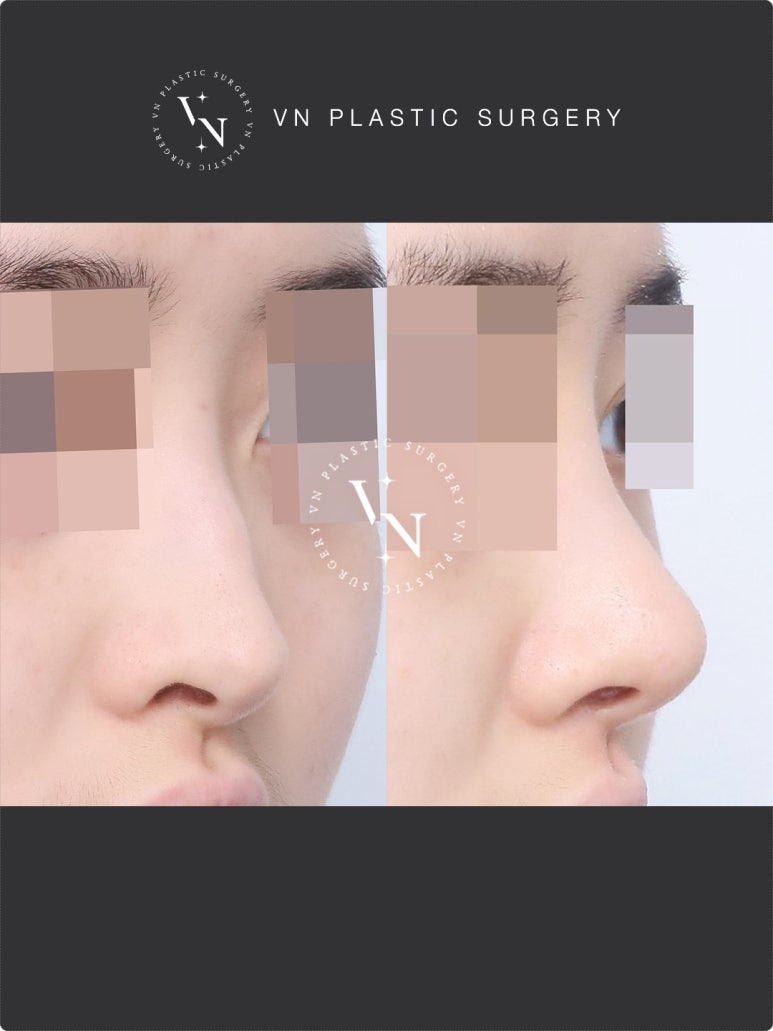 Nose Surgery Without Implants: The Shashaco Principle Using Autologous Cartilage and Real Cases image 4