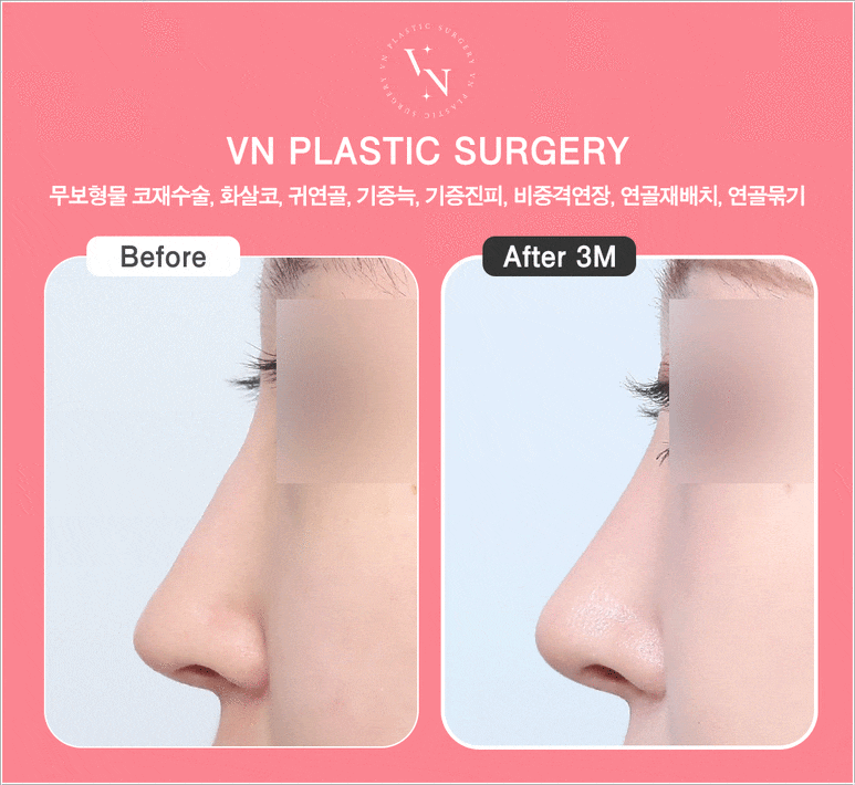 [코재수술잘하는곳] 원하는 코로 다시 바꿀 수 있을까? 관련 이미지 6