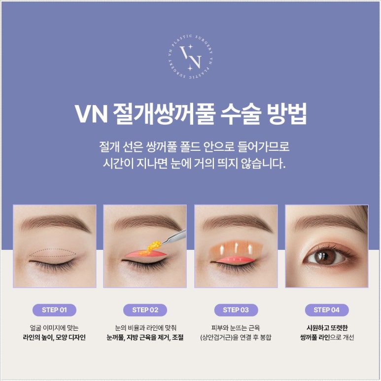 If You Need Incisional Double-Eyelid Surgery but Are Worried About Scars image 6