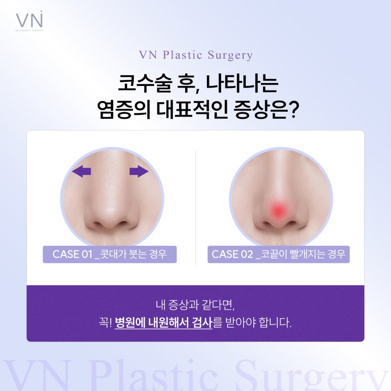 Should I Have a Nose Revision Surgery? image 3