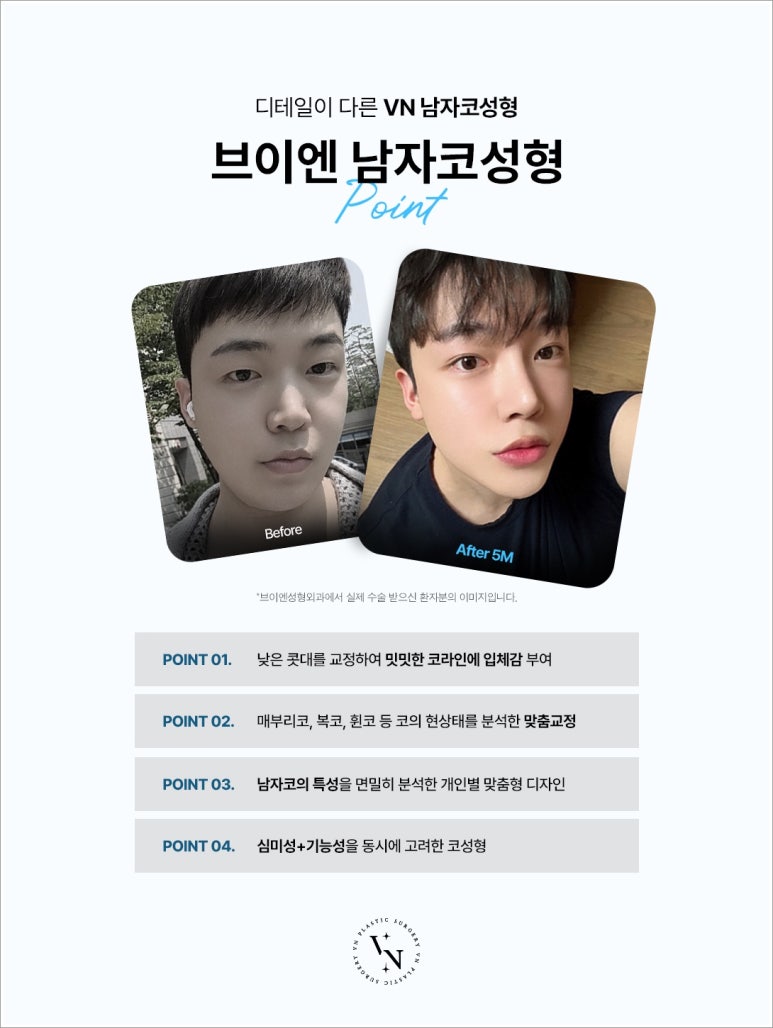 남자코성형가격 유형마다 차이 발생하는 이유 관련 이미지 2