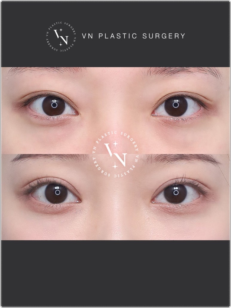 VN Plastic Surgery: If the Inline Looked Too Constricted and the Outline Felt Too Dramatic image 5