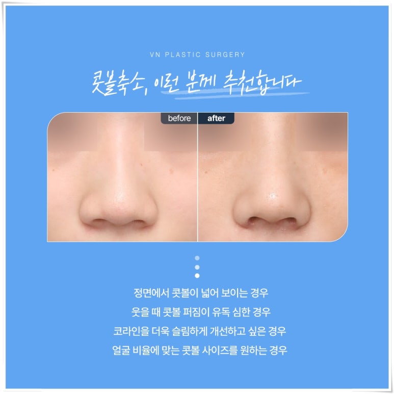 Concerned About Wide Nostrils? What to Know Before Consulting About Alar Reduction | 브이엔성형외과 image 6