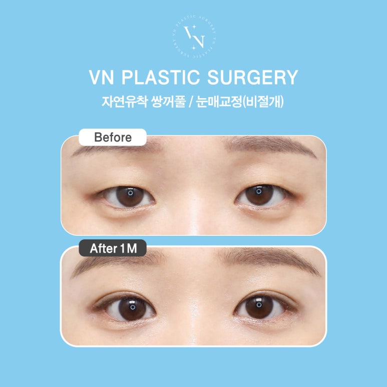 [Sinnonhyeon Plastic Surgery] Before Your First Double Eyelid Surgery, Be Sure to Check This! Do I Have Sunken Eyes or Protruding Eyes? image 8