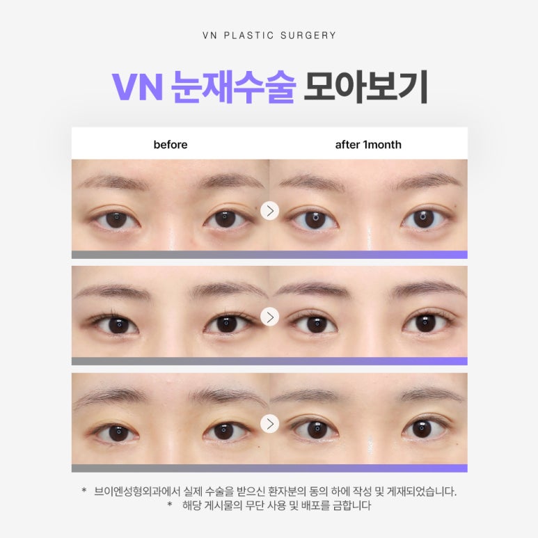 눈재수술, 브이엔성형외과에서 세심함으로 다시 완성💜✨ 관련 이미지 3