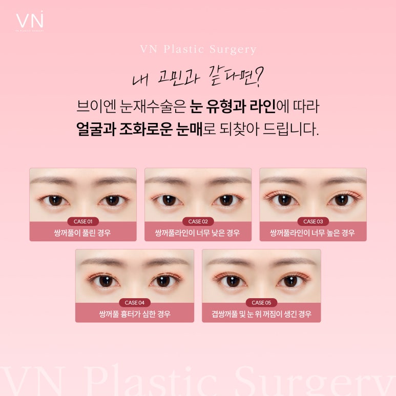 눈재수술이 가장 적당한 시기는 언제일까? 관련 이미지 4