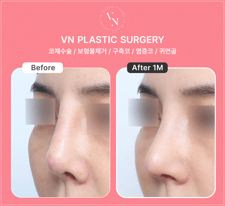 When Should Contracture Nose Revision Surgery Be Done? From Causes to Solutions (VN Plastic Surgery) image 7