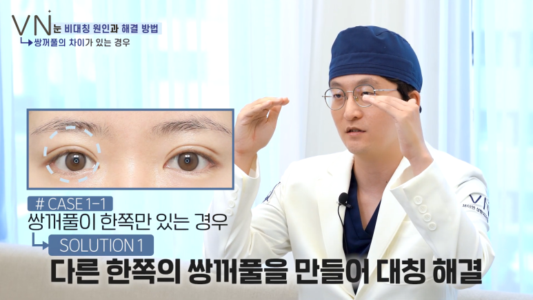 첫쌍꺼풀수술 전, 비대칭 짝눈의 원인과 해결법을 알아보자! 😀 관련 이미지 3