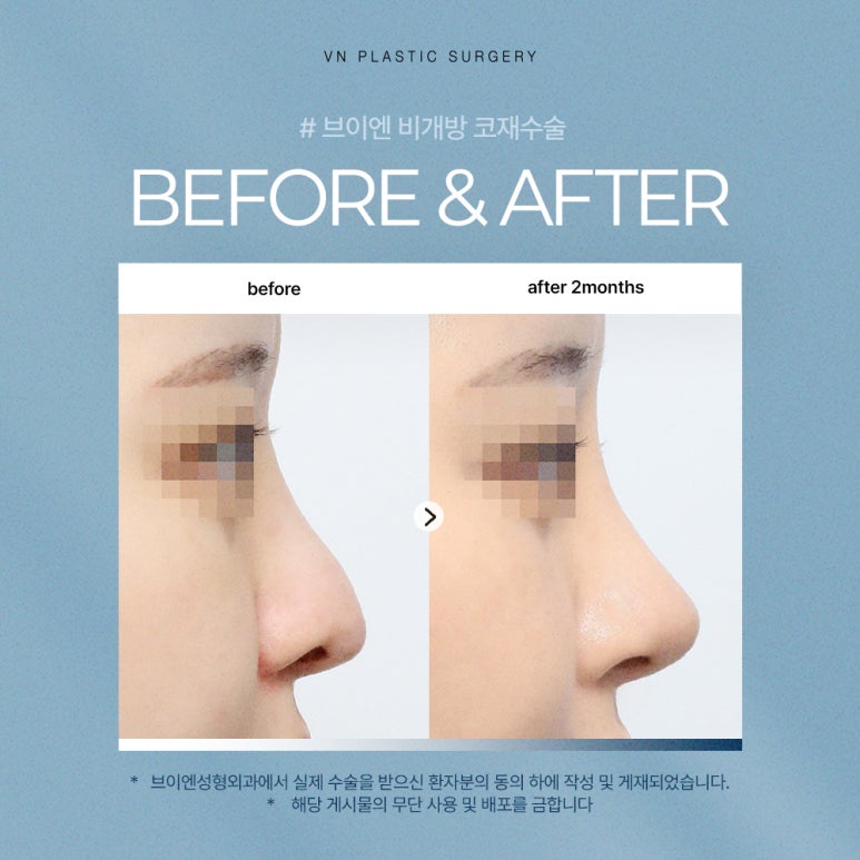 브이엔성형외과 비개방 코재수술, 꼭 알아야 할 정보✨ 관련 이미지 3