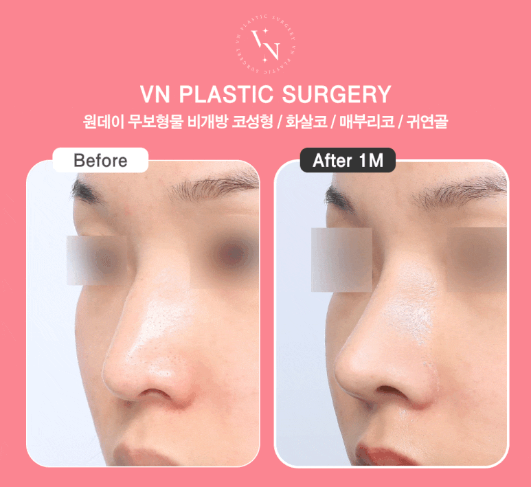 [Arrow Nose Correction in Sinnonhyeon/Gangnam] How to Fix a Nose That Looks Long and Change Your Impression ｜ VN Plastic Surgery image 5