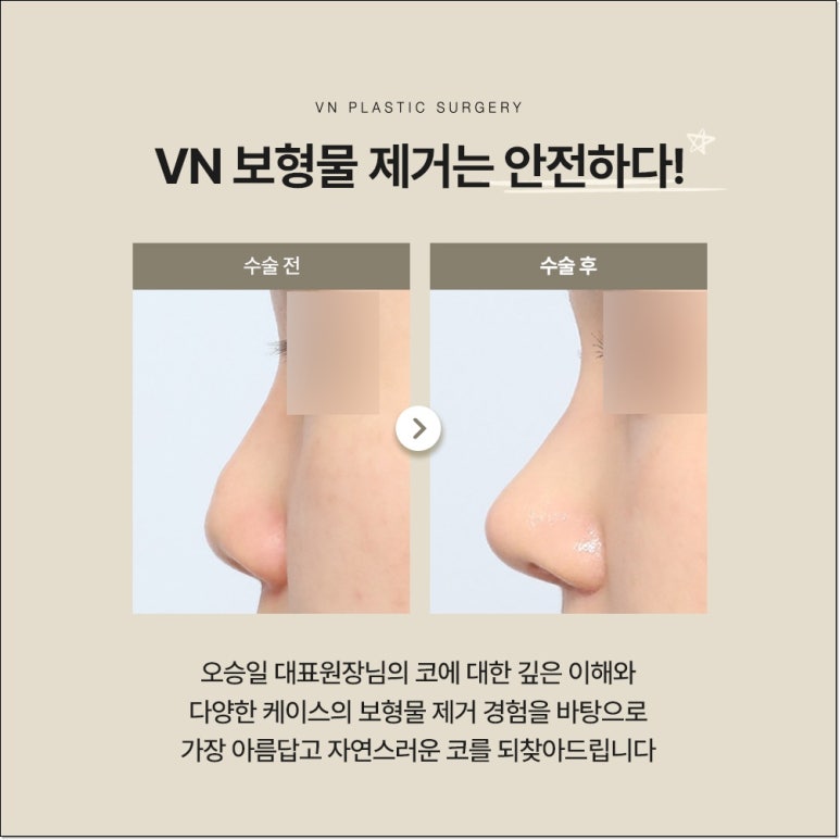 Types of Nasal Implant Removal to Know Before Revision Rhinoplasty | VN Plastic Surgery image 3