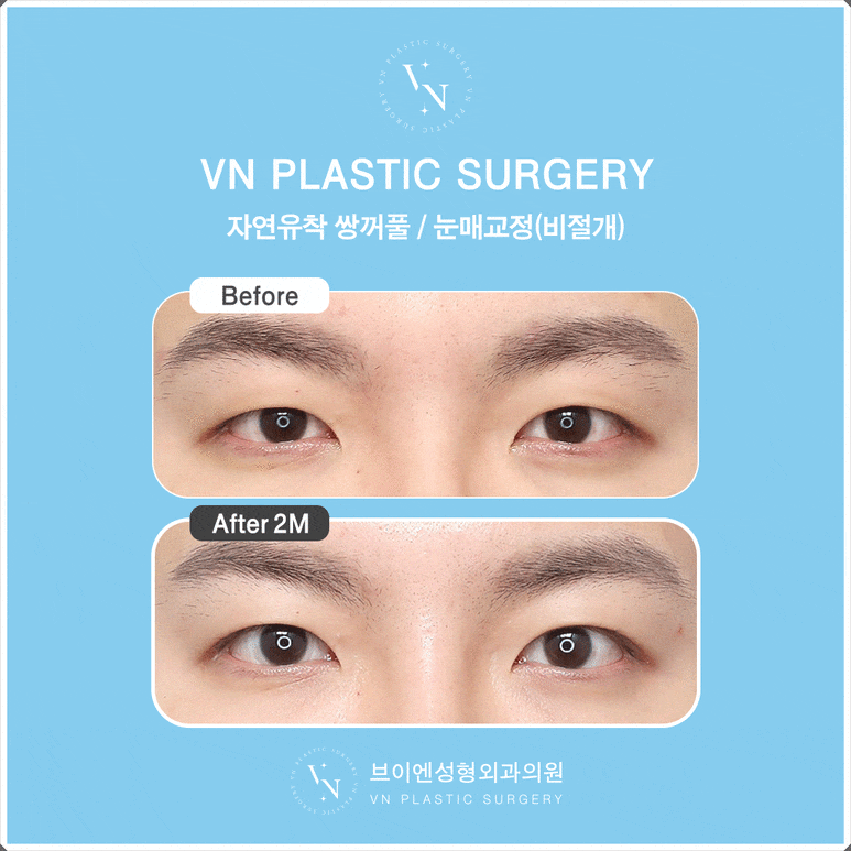 Male Eye Surgery: The Difference in Details That Create a Natural Eye Shape image 5