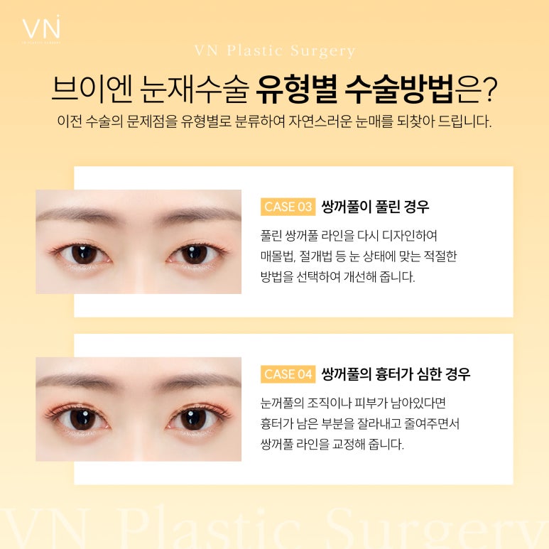 Revision Eyelid Surgery: How Can It Be the Last Surgery? image 4
