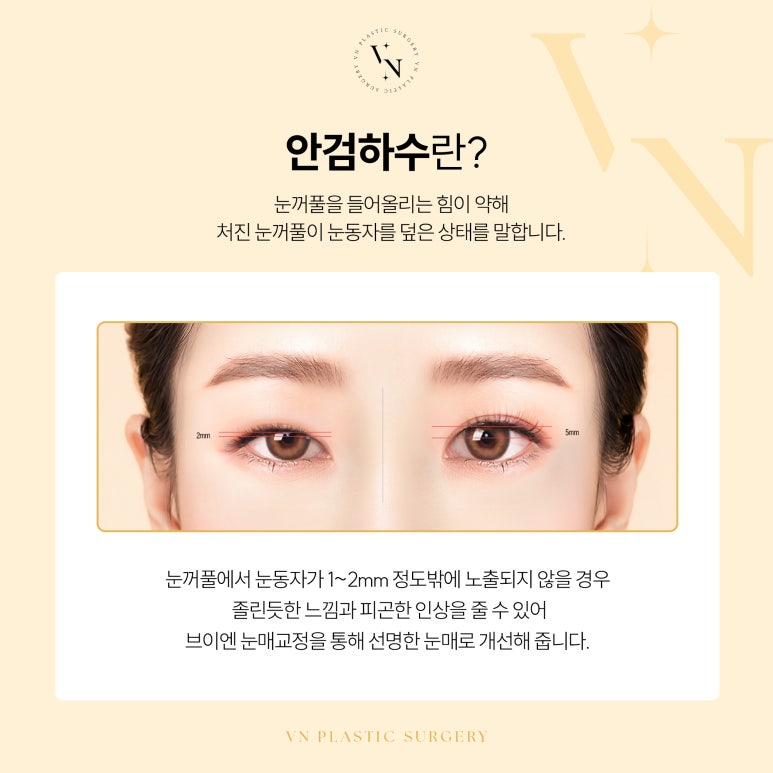 졸려 보이는 눈, 어떻게 해야 하나요? 관련 이미지 2