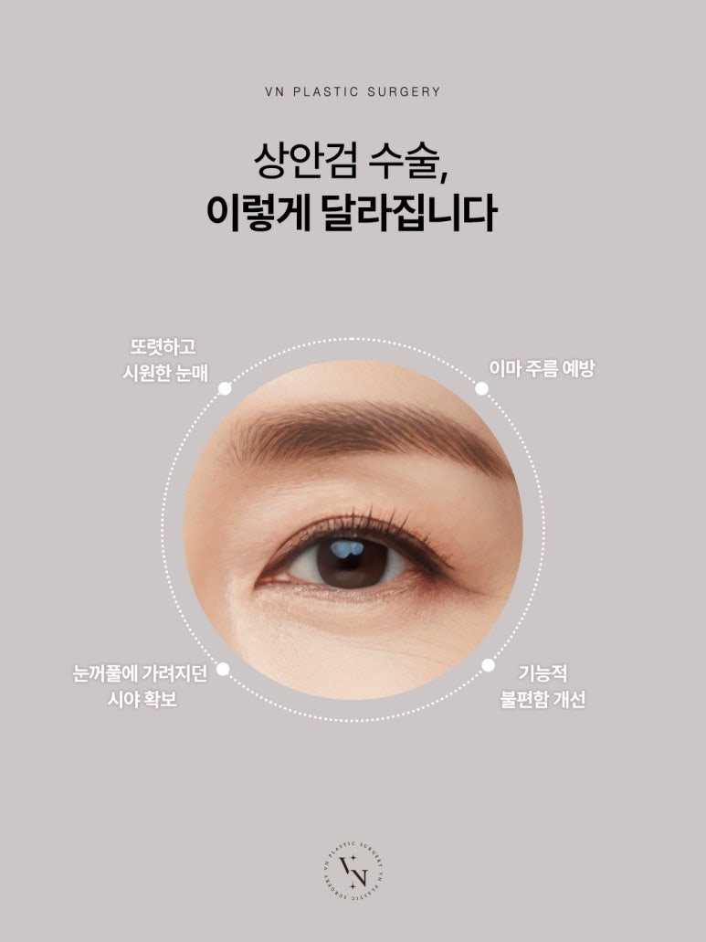 How to Effectively Address Drooping Eyelids with Upper Blepharoplasty, VN Plastic Surgery image 3