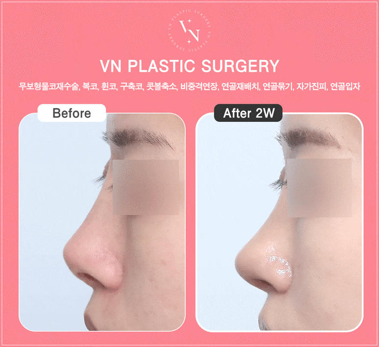 When Should Contracture Nose Revision Surgery Be Done? From Causes to Solutions (VN Plastic Surgery) image 8