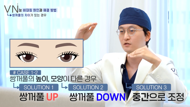 첫쌍꺼풀수술 전, 비대칭 짝눈의 원인과 해결법을 알아보자! 😀 관련 이미지 4