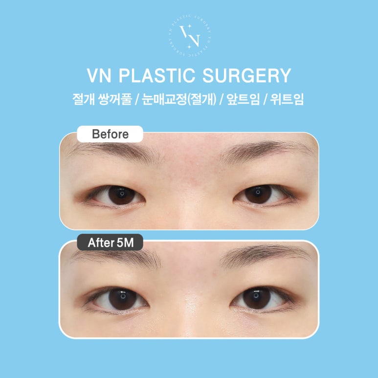 [Gangnam/Sinnonhyeon VN Plastic Surgery] Post-College Entrance Exam Double Eyelids Surgery Is Timed Perfectly Now! image 6