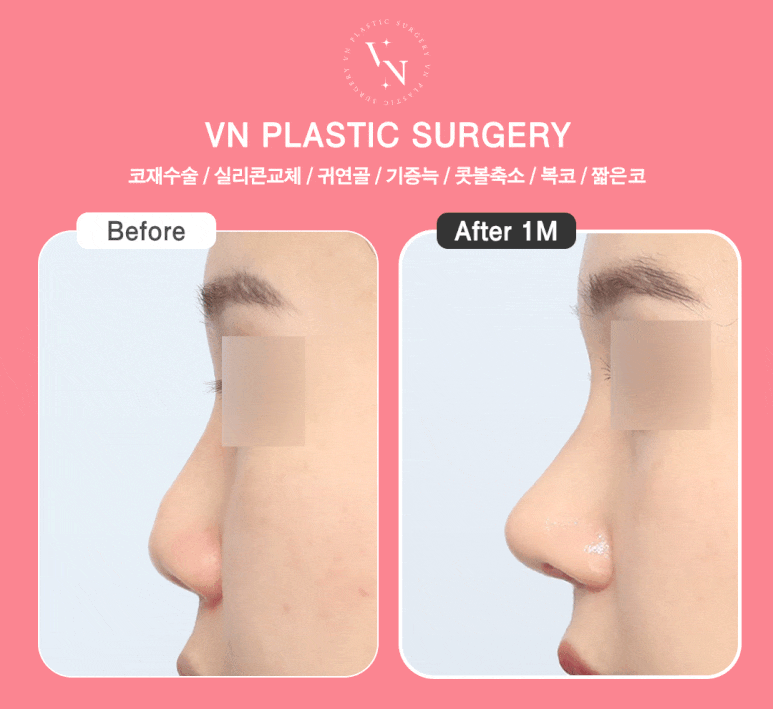 Short Nose Surgery at a Plastic Surgery Clinic in Sinnonhyeon: Key Points for Restoring Facial Proportions image 8