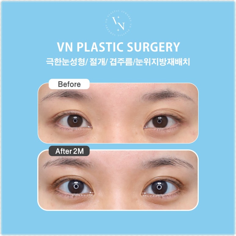 Why Extreme Eye Revision Surgery Is Difficult for Hooded Eyes, Asymmetric Eyes, and Double Fold Correction [VN Plastic Surgery, Gangnam] image 3