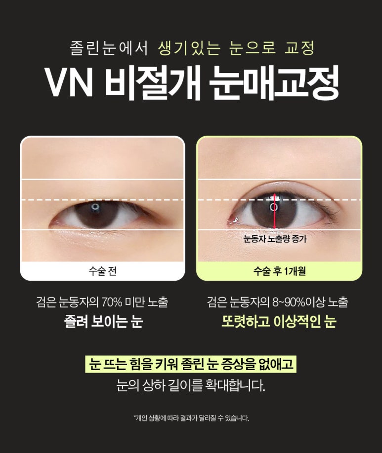 수험생만을 위한 특별한 눈성형 혜택, [브이엔성형외과, 수능눈성형] 관련 이미지 5