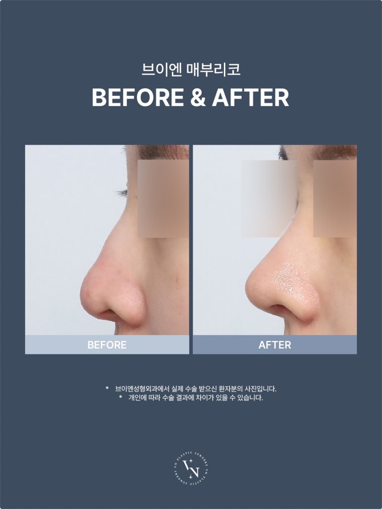 Why Does the Cost of Hump Nose Surgery Vary by Clinic? 5 Reasons for the Price Difference image 3