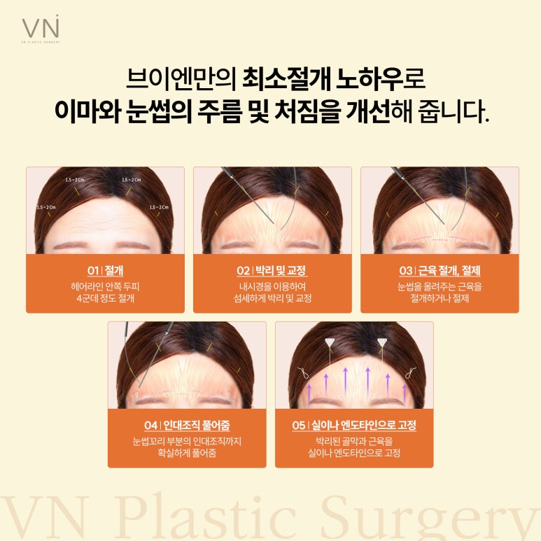 이마 리프팅과 눈썹 교정을 한번에, 이마눈썹거상 관련 이미지 3