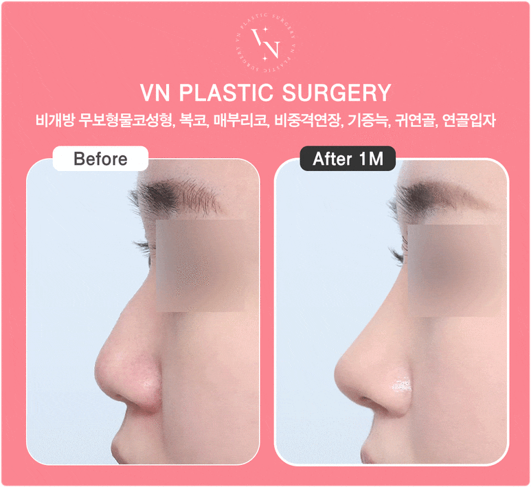 Cartilage Particle Rhinoplasty (Shasha Nose): Why Finely Mince the Cartilage? image 6