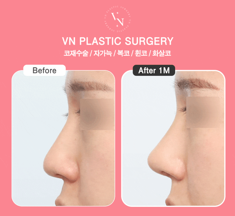 [Gangnam/Sinnonhyeon VN Plastic Surgery] Autologous Rib Cartilage Surgery: Rhinoplasty Tips to Reduce Pain and Recovery Concerns image 6