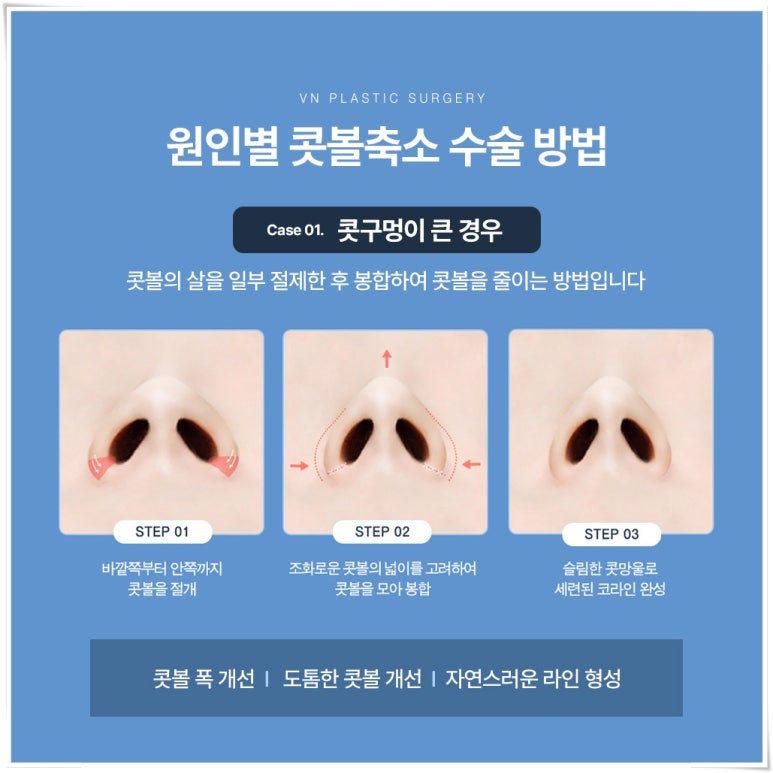 Concerned About Wide Nostrils? What to Know Before Consulting About Alar Reduction | 브이엔성형외과 image 3