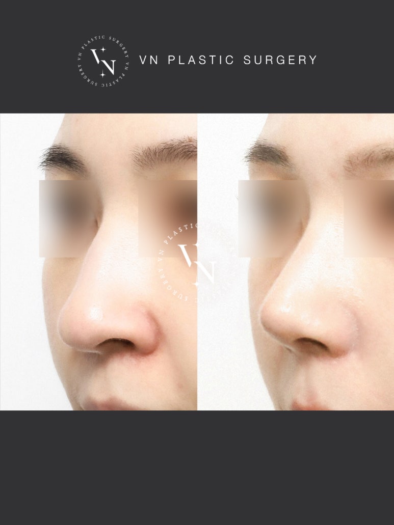 [Sinnonhyeon Plastic Surgery] If Your Hump Nose Is Stressing You Out, Be Sure to Read This image 6