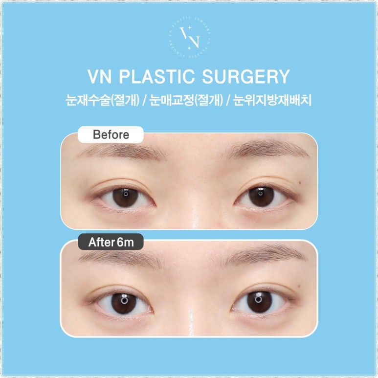 Why Extreme Eye Revision Surgery Is Difficult for Hooded Eyes, Asymmetric Eyes, and Double Fold Correction [VN Plastic Surgery, Gangnam] image 7