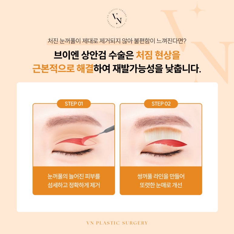 VN Plastic Surgery: If You’re Worried That Your Expression Looks Harsh After Eye Surgery image 3