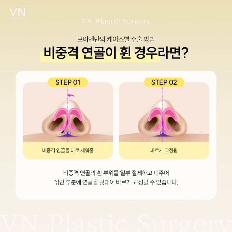 Is there a possibility of recurrence after crooked nose surgery correction? image 5