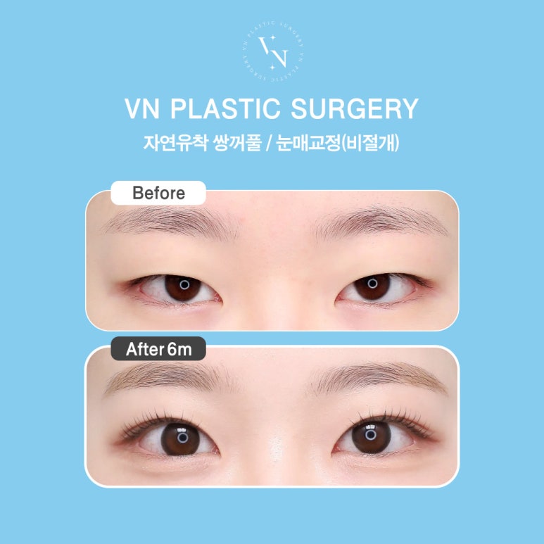 If You’re Looking for a Place That Does Eye Surgery Well, VN Plastic Surgery Is Different in the Details image 6
