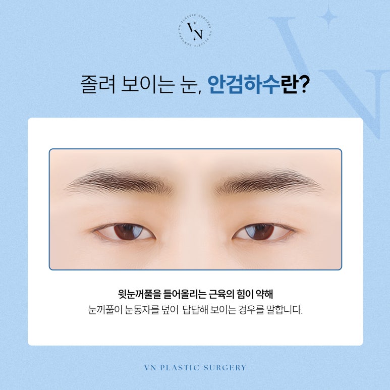 Vn Plastic Surgery: Male Eye Surgery to Correct Ptosis image 2