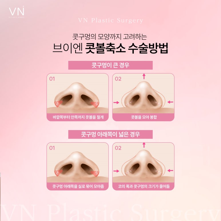 Can Bulbous, Wide Nasal Tip Improvement Be Achieved with Alar Reduction Surgery? image 3