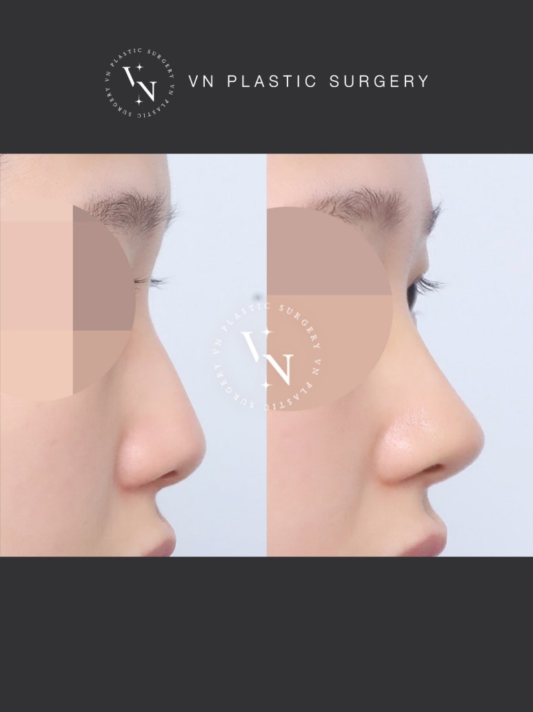 [Sinnonhyeon Plastic Surgery] If Your Hump Nose Is Stressing You Out, Be Sure to Read This image 8