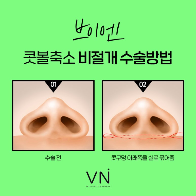 Let’s Get Rid of the Bulbous Nose! Learn About Nostril Reduction Surgery image 5