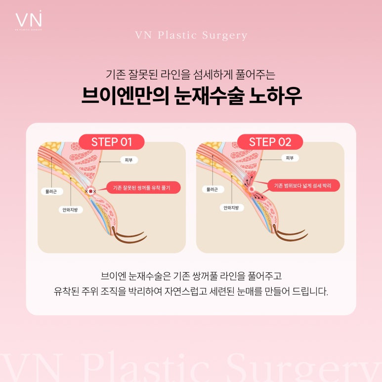 눈재수술, 첫수술후 언제부터 가능할까요? 관련 이미지 4