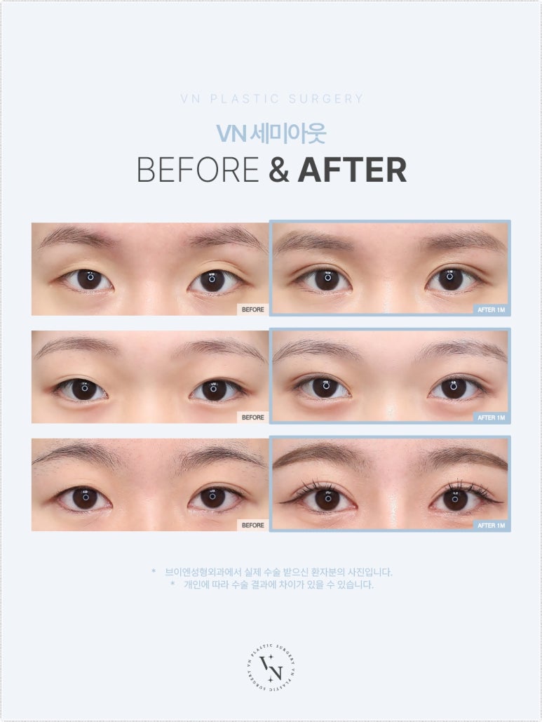 세미아웃라인유명한곳 브이엔성형외과에서 알아보는 라인 디자인 관련 이미지 3