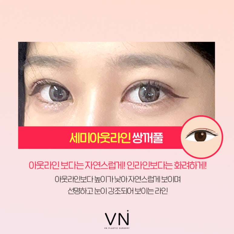 인라인? 아웃라인? 쌍꺼풀수술라인 종류 알아보기 (+연예인 쌍꺼풀) 관련 이미지 6