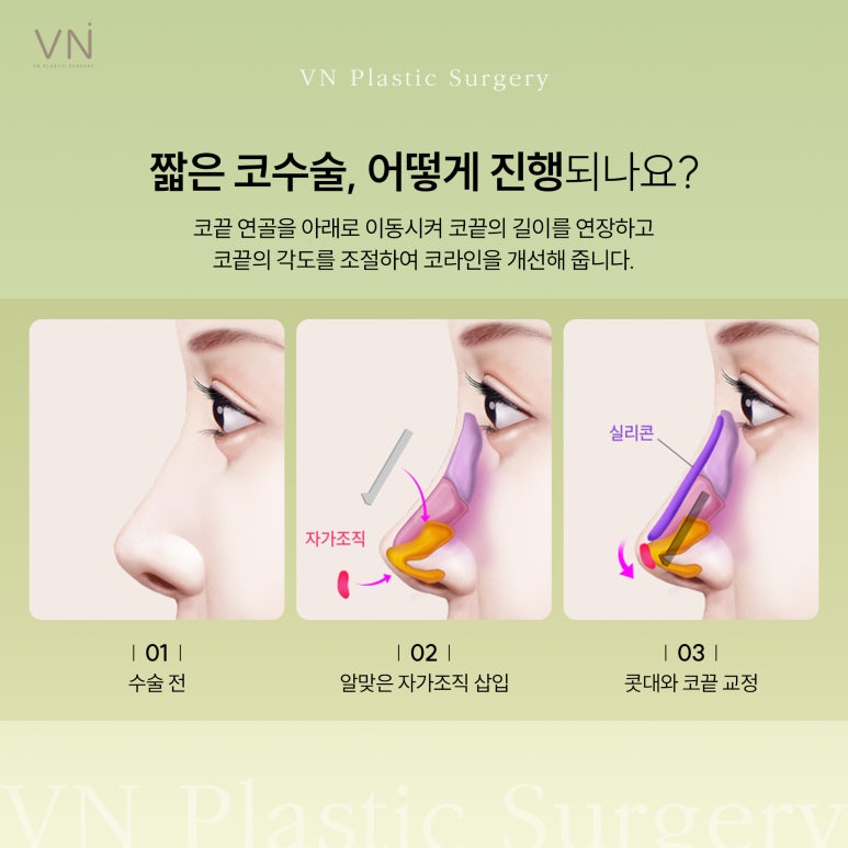 짧은코 코수술은 어떻게 진행할까요? 관련 이미지 3