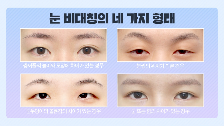 첫쌍꺼풀수술 전, 비대칭 짝눈의 원인과 해결법을 알아보자! 😀 관련 이미지 2