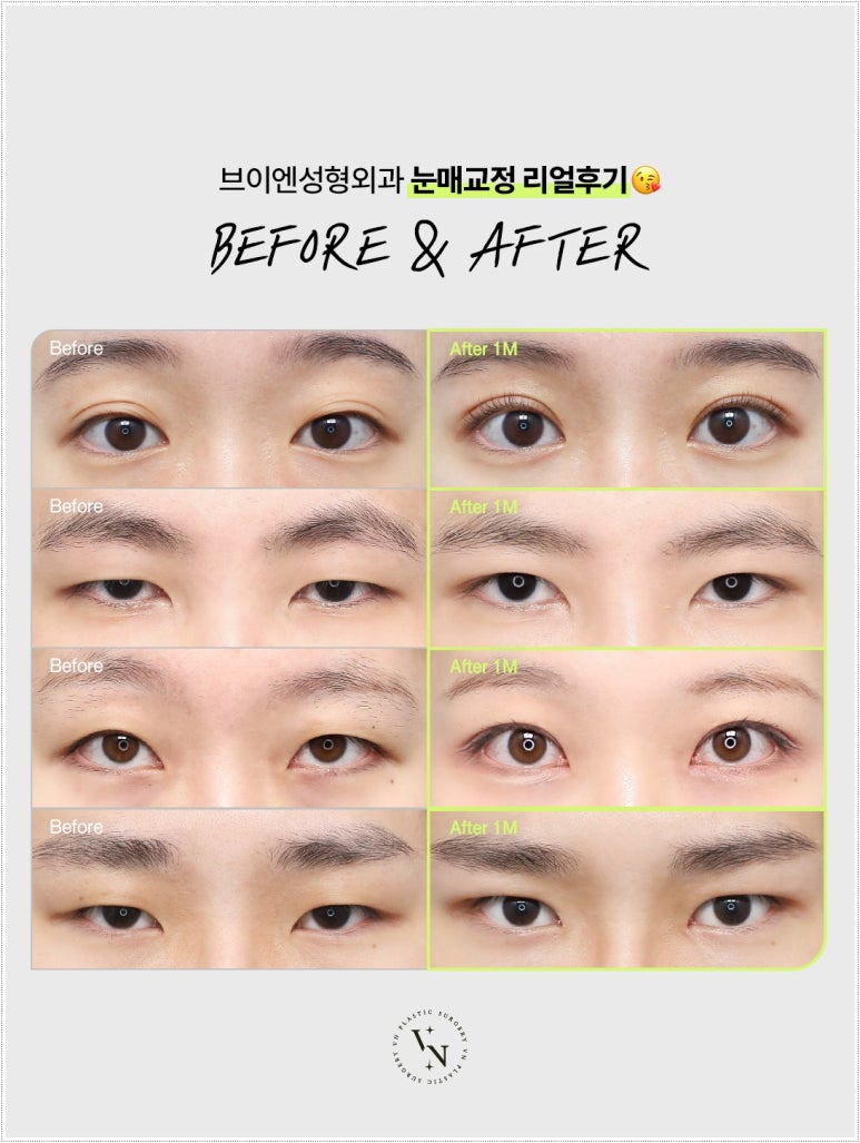 How Eyelid Correction Changes the Eyes: Comparison of Incision and Non-Incision Methods and Recovery Time image 3