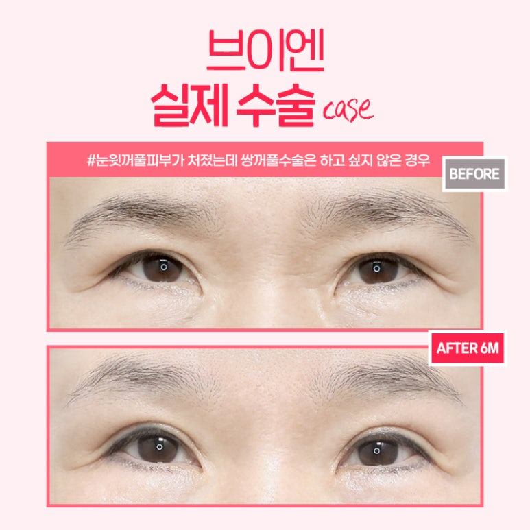 대표적인 중년눈성형 알아보기 I 브이엔성형외과 관련 이미지 4